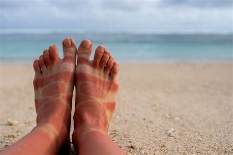 Free Photo Details Of A Womans Sunburn Skin From The Beach Sun