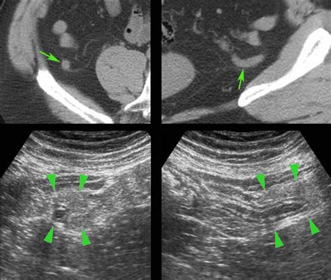 Perforated Appendix Ultrasound