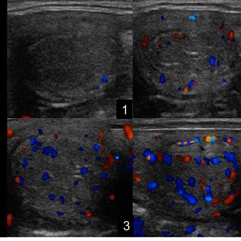 Color Doppler Sonograms Representing Scores Used To Evaluate