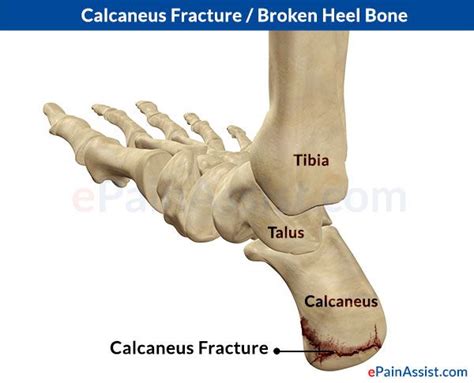 Calcaneus Calcaneus Fracture Or Broken Heel Types Causes Symptoms