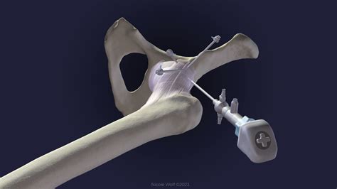 J Bone Joint Surg On Twitter Harvest And Application Of Bone Marrow