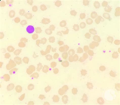 ACANTHOCYTES IN PERIPHERAL BLOOD SMEAR 1