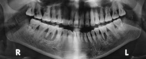 Orthopantomogram OPG X Ray Machine Dental X Rays Purpose 48 OFF