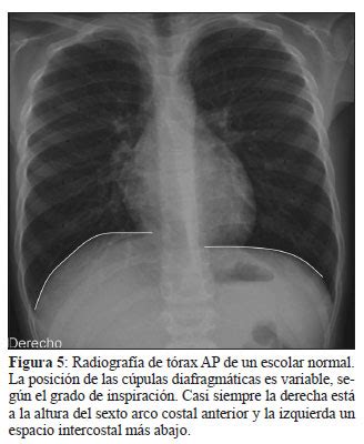Evaluaci N Por Im Genes Del Diafragma En El Ni O