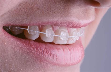 What To Know About Getting Braces On Your Teeth After 50