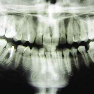 An Orthopantomogram Showing Radiolucency At The Apex Of Teeth 26 And