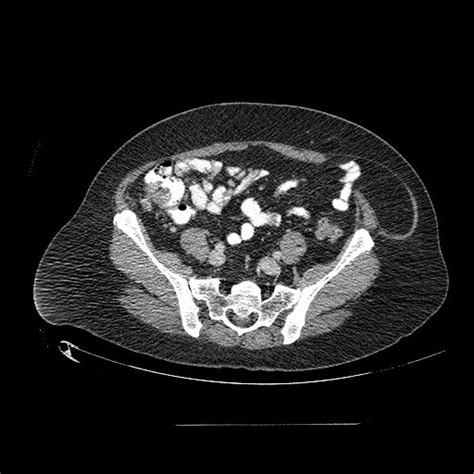 Radiopaedia Case Spigelian Hernia Id 12300 Study 12588 NC Commons