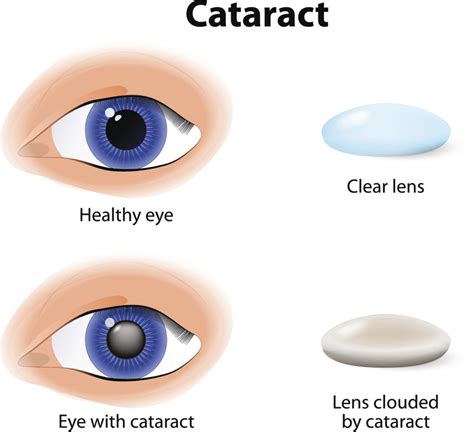 Signs And Symptoms Of Cataracts Swagel Wootton Eye Institute