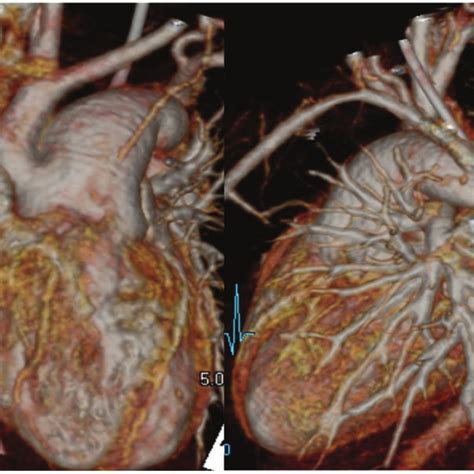 Preoperative Computed Tomography Scan And 3 Dimensional Reconstruction Download Scientific