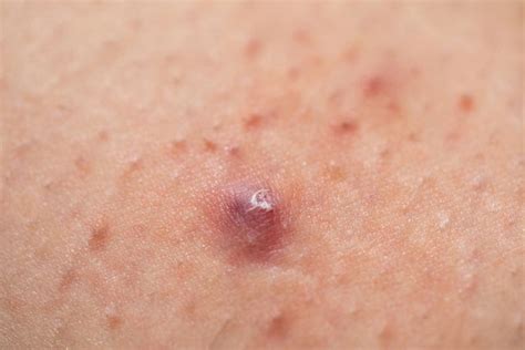 Foliculitis qué es causas y tratamiento Fotos Tua Saúde