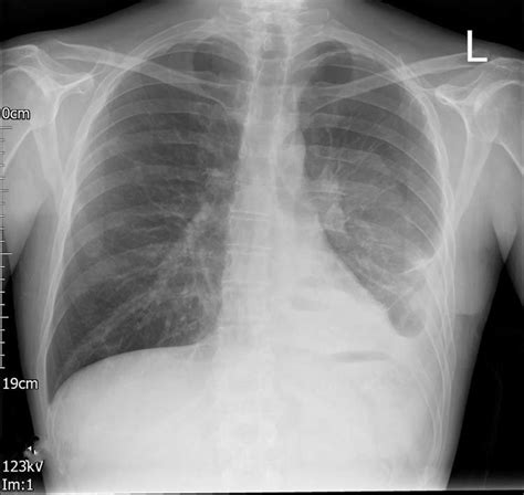 Left Vats Post Operative Posterior Anterior Chest Radiograph Showing No