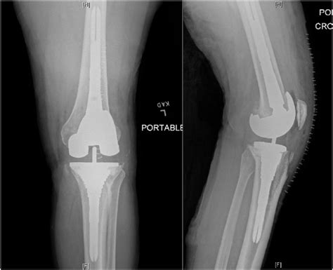 Immediate Postoperative Radiographs Postoperative Anteroposterior A