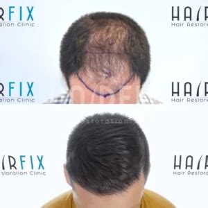 Popular Hair Loss Myths Debunked Hairfix