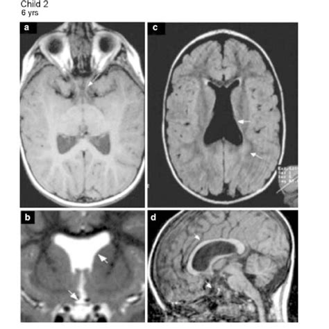 MRI structures of optic nerves, chiasm and optic tracts are presented ...