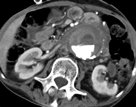 Abdominal Aortic Aneurysms Revisited MDCT With Multiplanar