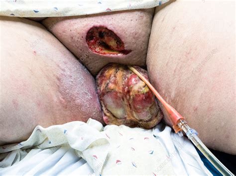 Scrotal Abscess