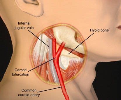 How Long Can You Live With Blocked Carotid Arteries Turgid Journal