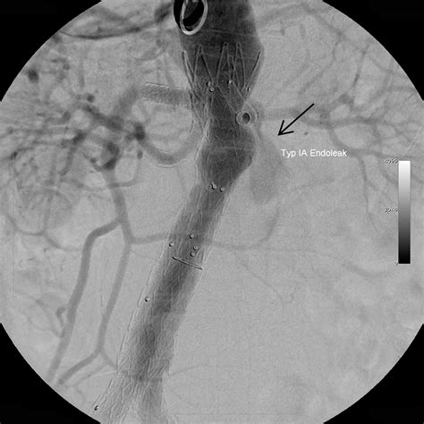 Effectiveness Of Intra Arterial Aneurysm Sac Embolization For Type Ia