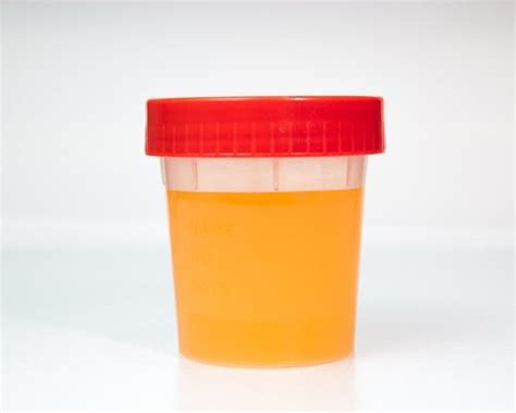 Why Is My Urine Orange? - Tafmed research