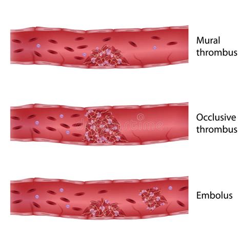 5 Types Of Thrombosis Thrombosis Webmd | Venzero