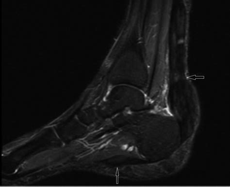 Multiple Tendon Xanthomas In Patient With Heterozygous Familial