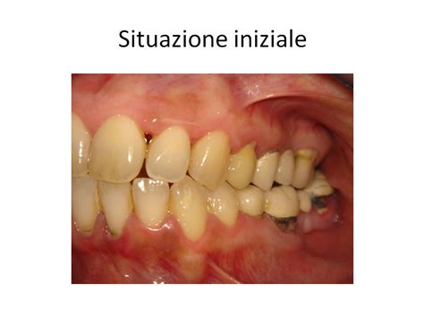 Rigenerazione Ossea Impianti Post Rigenerazione Dentista Roma