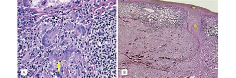 A Granulomatous Infiltrate With Multinucleated Giant Cells Yellow