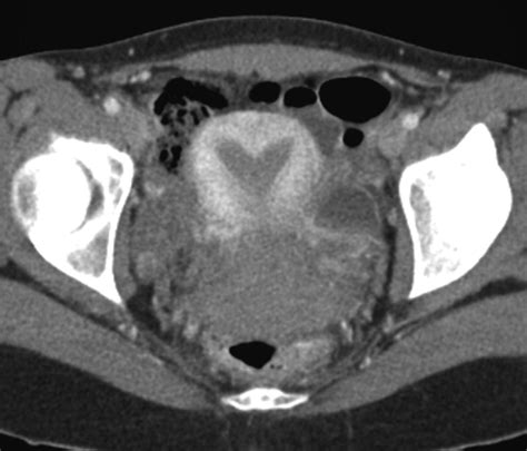 Normal Or Abnormal Demystifying Uterine And Cervical Contrast