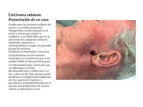 Ppt Carcinoma Sebáceo Presentación De Un Caso Clasificamos Los Tumores Malignos De Piel En Un