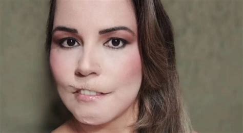 Influencer perde lábios após harmonização facial veja antes e depois