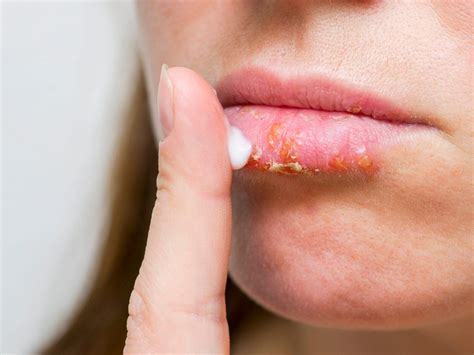 How To Avoid Dry Lips Hirebother13