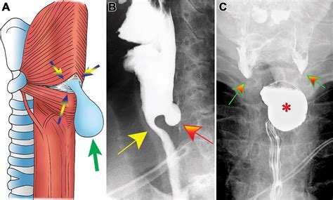 Fluoroscopic Swallowing Examination Radiologic Findings And Analysis Of Their Causes And