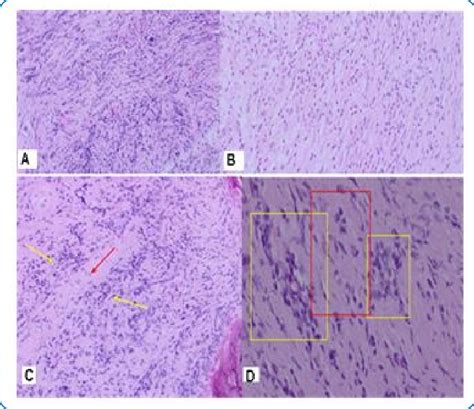 Microscopic Histological Findings А Spindle Cells Show Interlacing