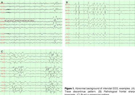 Figure 1 from EEG Characteristics of Full-Term Neonatal Seizures ...