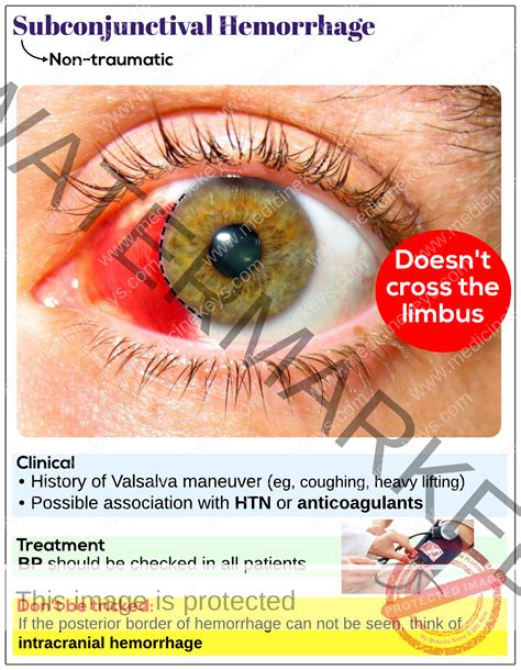 Subconjunctival Hemorrhage Non Traumatic Medicine Keys For MRCPs