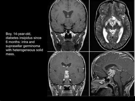 Mri Imaging Hypothalamus Dr Ahmed Esawy Ppt