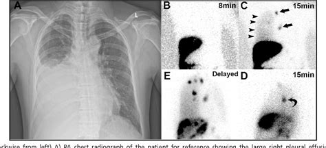 Figure From Unusual Mediastinal Lymph Node Uptake And