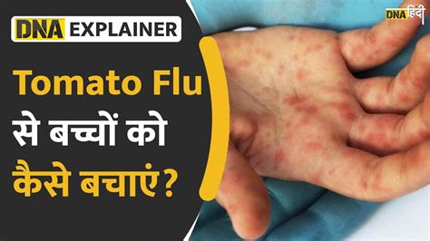 Video क्या भारत को टोमैटो फ्लू से डरने की जरूरत है Dna Hindi