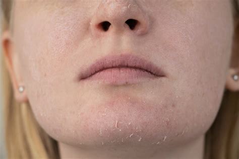 Dry Skin Patches On Face