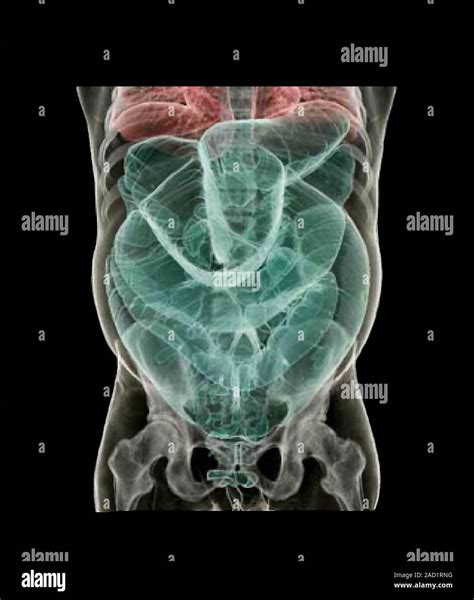 Abnormally large intestine. Coloured 3D computed tomography (CT) scan ...