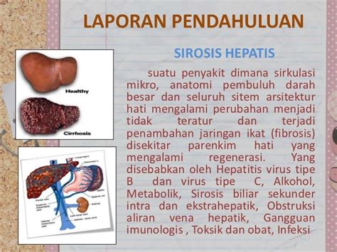 Sirosis Hepatis