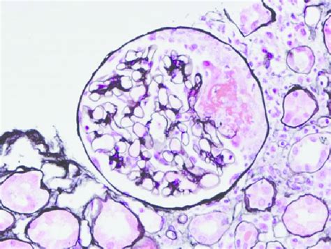 Renal Biopsy From Patient 2 Silver Stain Showing Glomerulus With Download Scientific Diagram