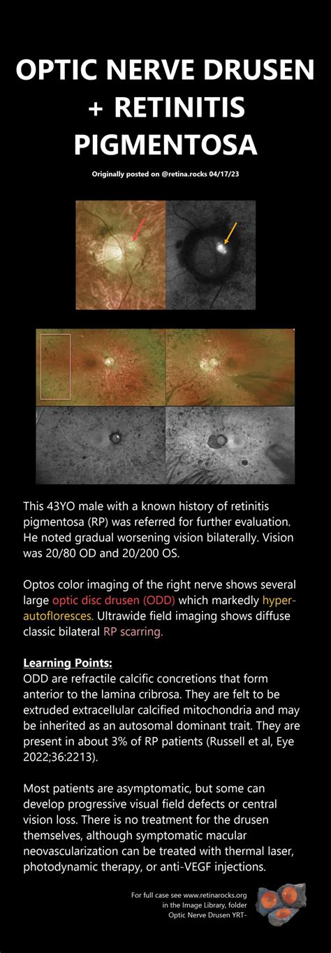 Optic Nerve Disorders Optic Nerve Drusen Retina Rocks