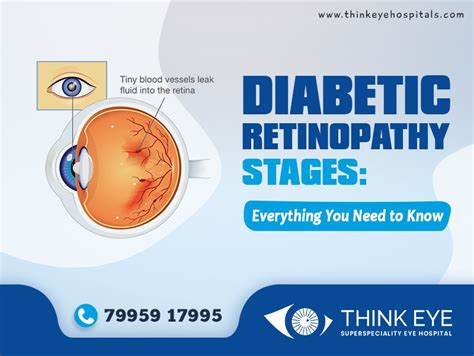 Diabetic Retinopathy Stages: Everything You Need to Know - Think Eye ...