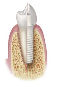 Implantatsioon Virudent Hambaravi