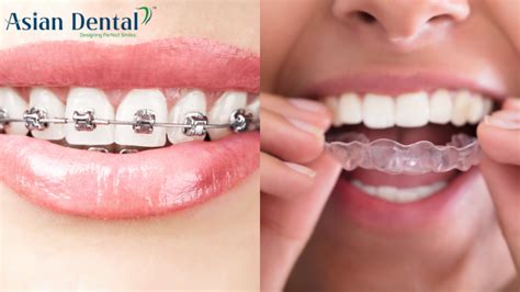 Braces Vs Clear Aligners Orthodontic Treatment In Vijayawada