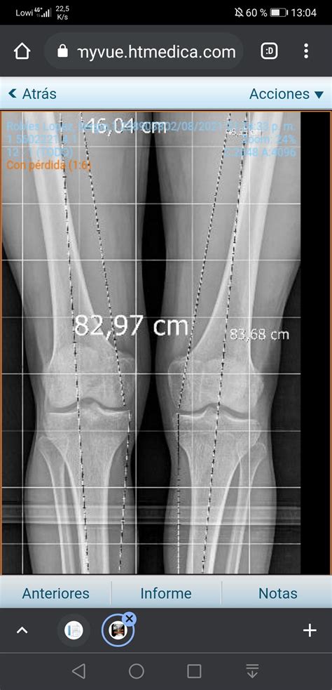 Knee Osteoarthritis R Xrays