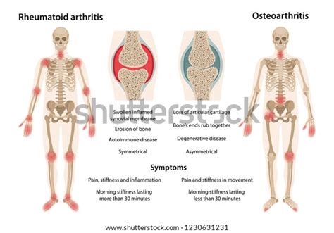 Difference Between Rheumatoid Arthritis Osteoarthritis On Stock Vector Royalty Free 1230631231