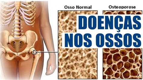 Doenças dos Ossos?! 💀 Saiba como Tratar a Doenças dos Ossos! - YouTube