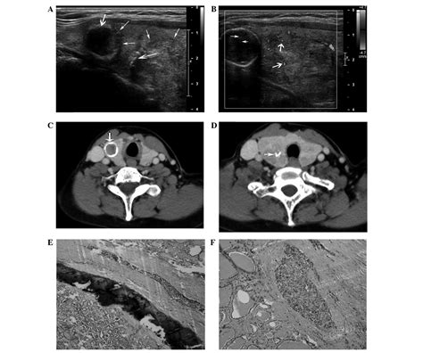 Follicular Thyroid Cancer Ultrasound